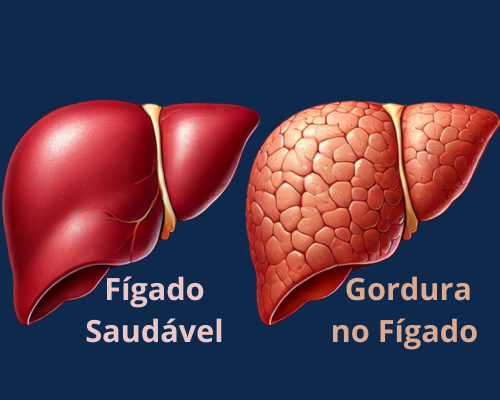 repesentação de um fígado saudável e m com gosruda.